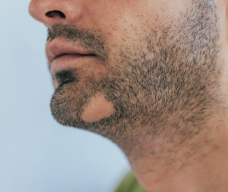 Beard Transplant