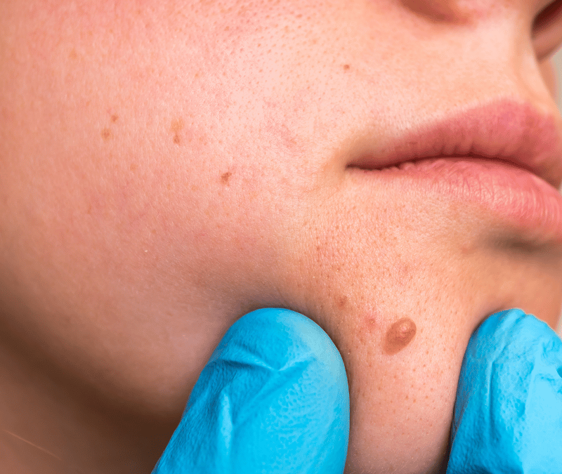 Birthmark Removal