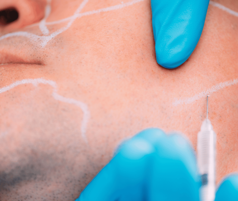 Dermal Fillers