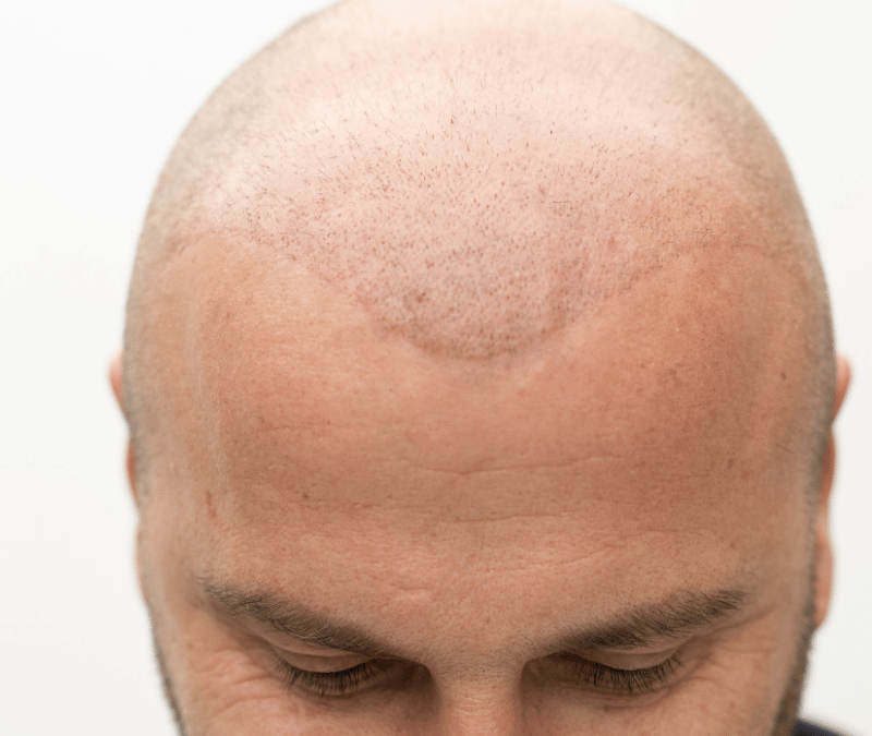 Direct Hair Implantation (DHI)