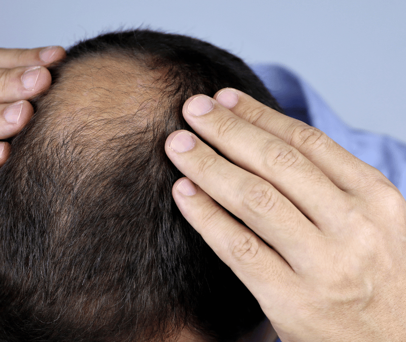 Hair Loss Treatment