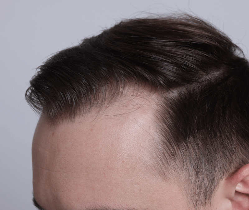 Hairline Design