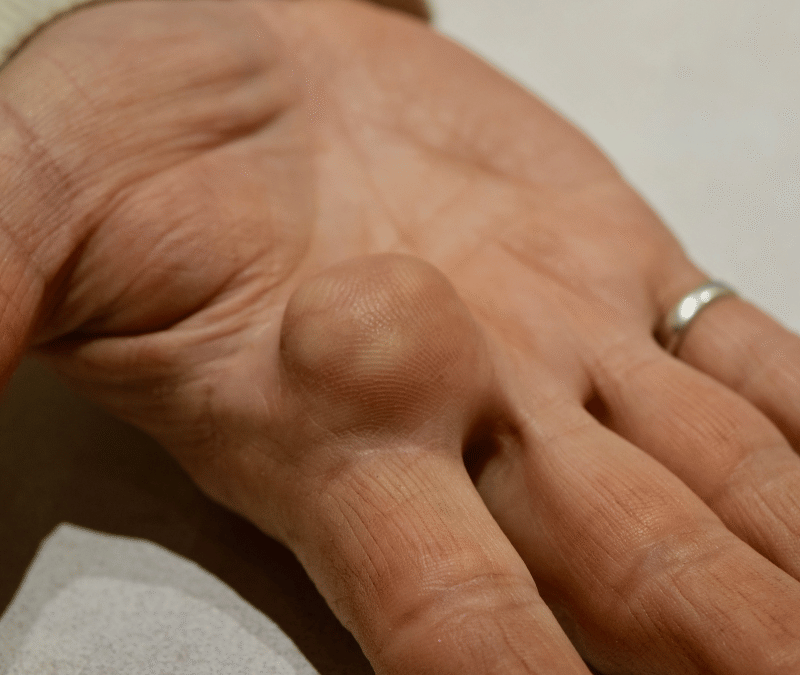 Lipoma Removal