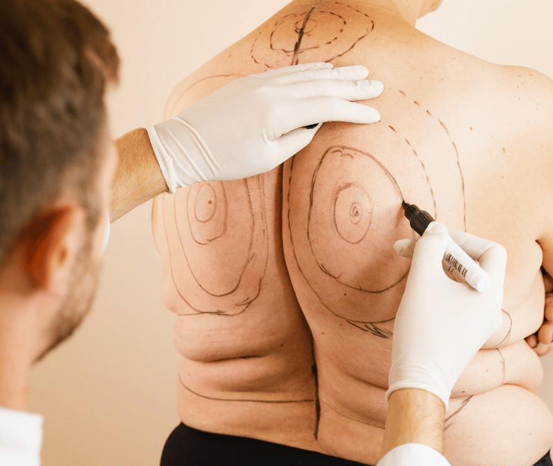Liposuction