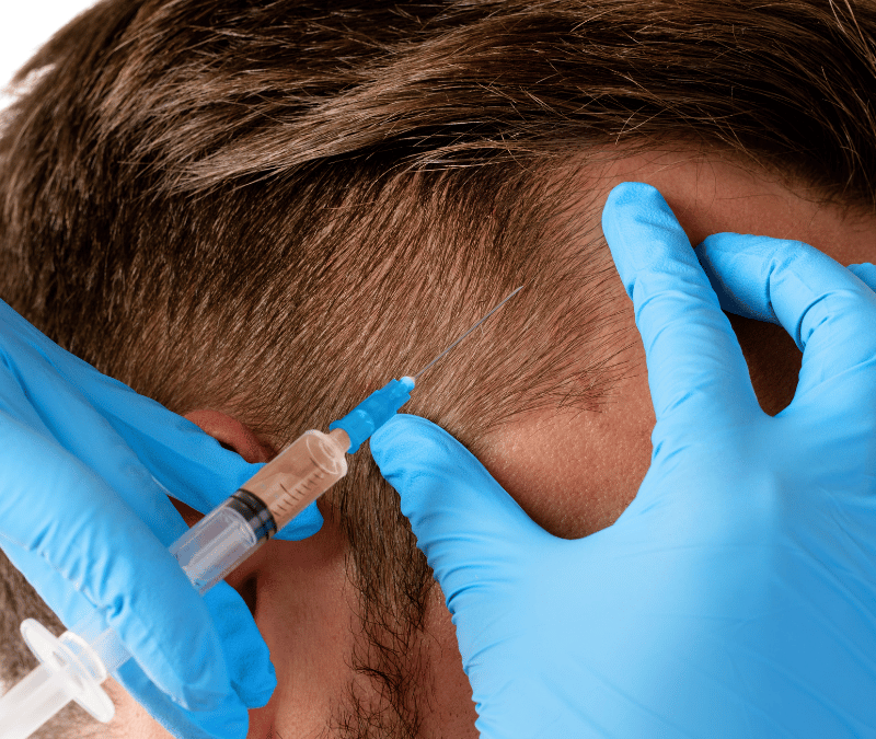 Microneedling