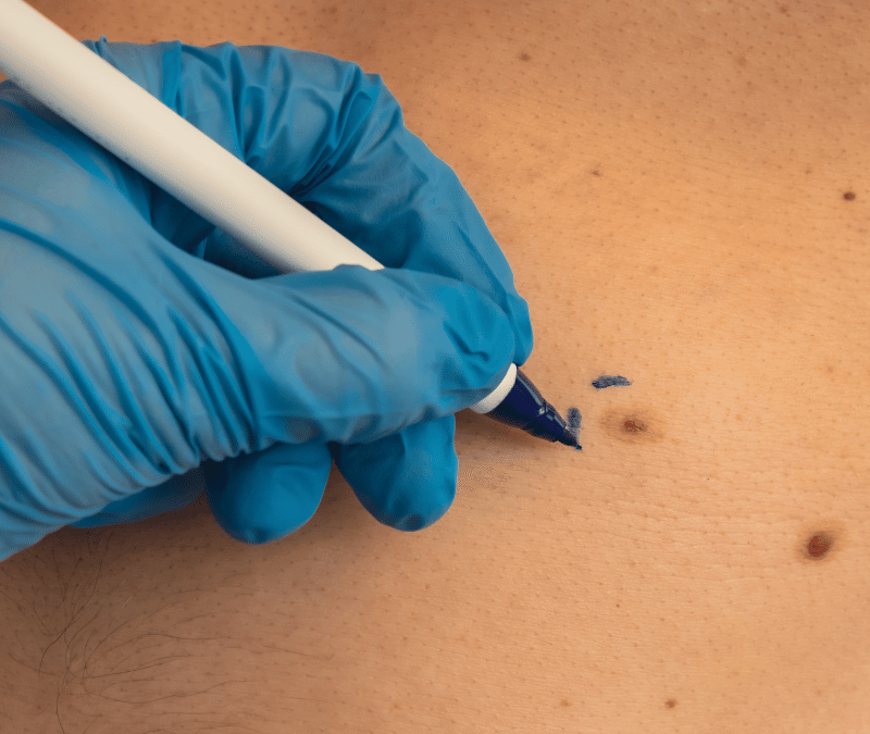 Mole Removal
