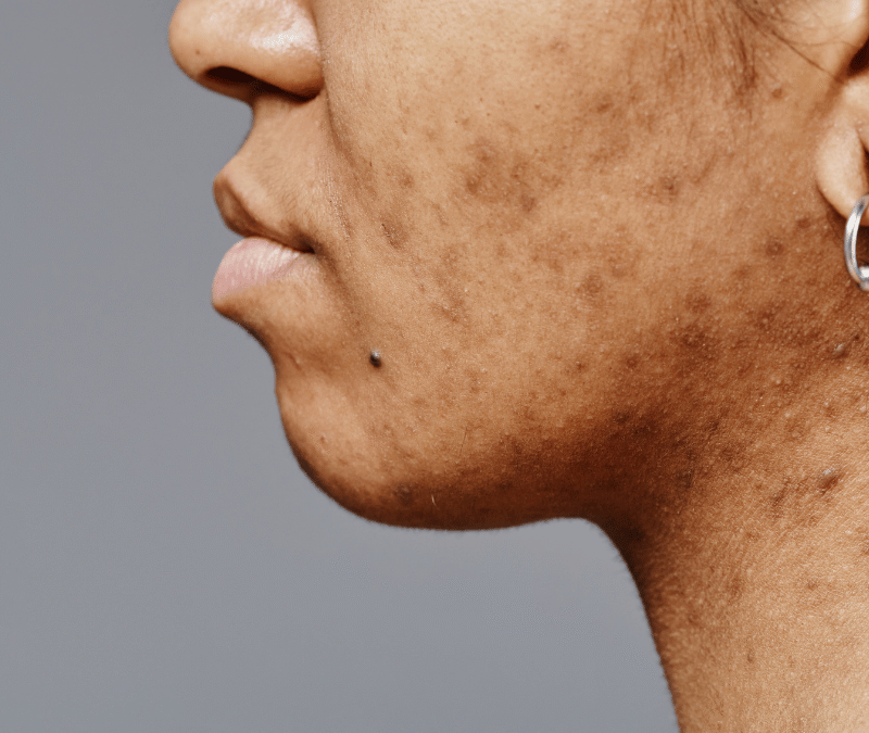 Scar Revision