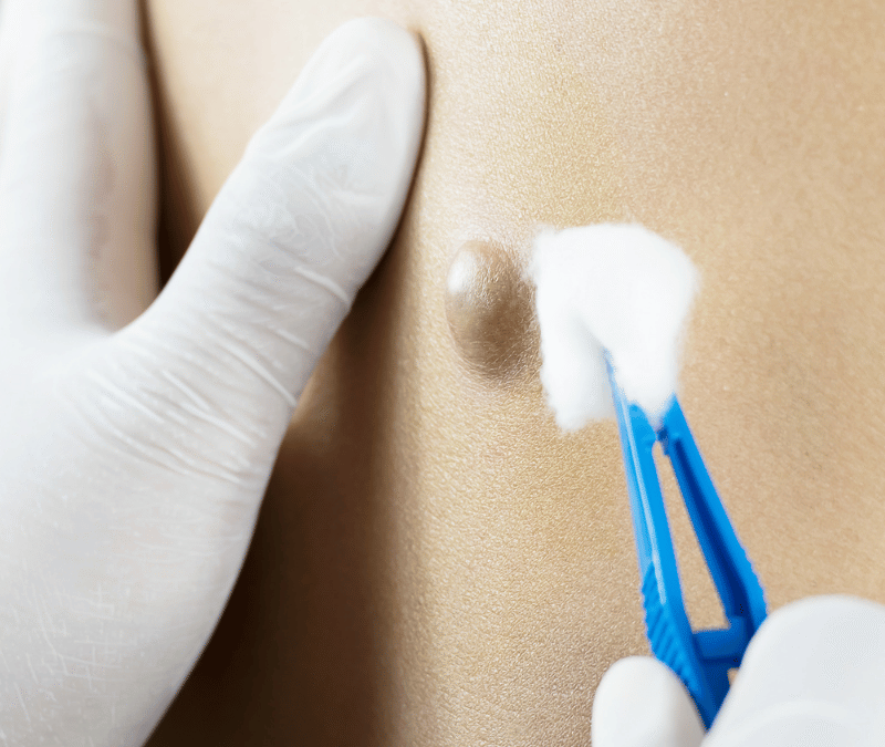 Sebaceous Cyst Removal