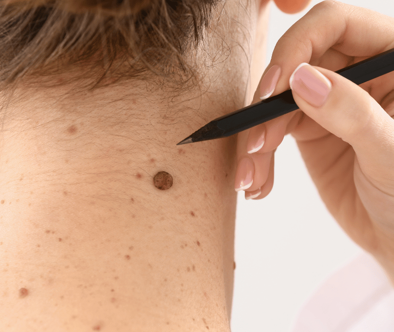 Skin Tag Removal